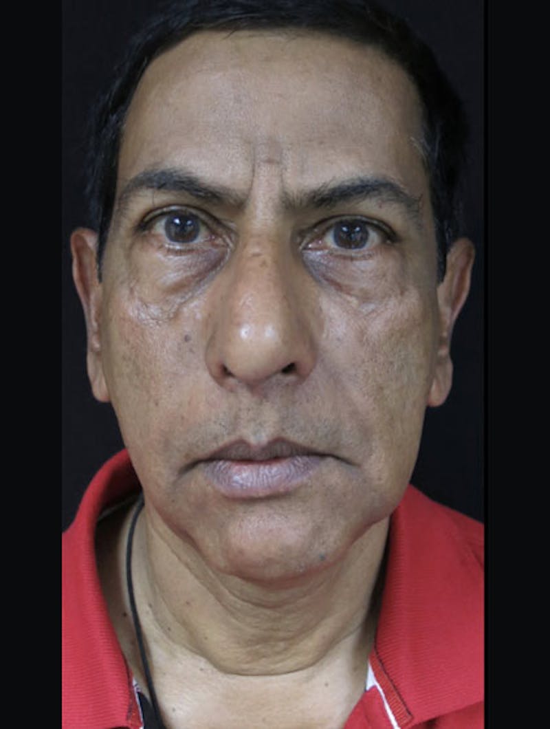 Face & Neck Lift Before & After Gallery - Patient 122908969 - Image 1