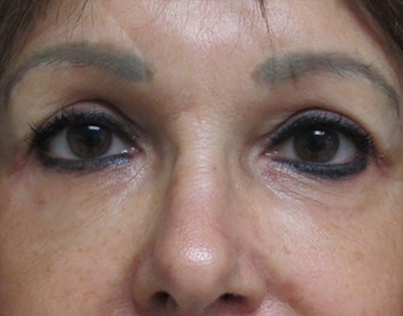 Eyelid Surgery Before & After Gallery - Patient 122908963 - Image 2