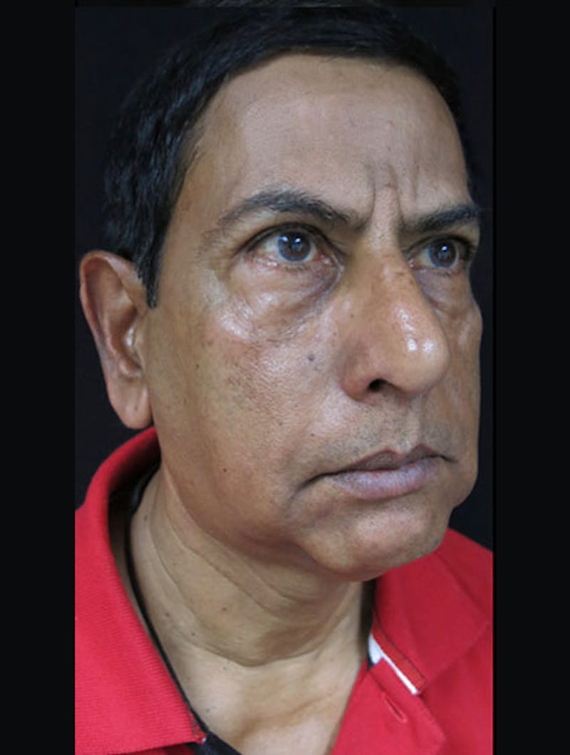 Face & Neck Lift Before & After Gallery - Patient 122908969 - Image 3