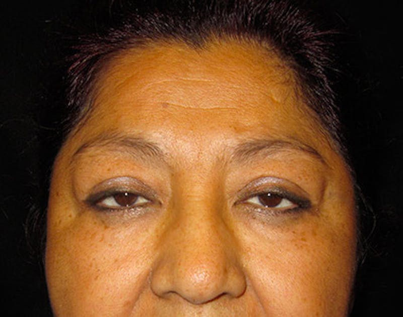 Eyelid Surgery Before & After Gallery - Patient 122908965 - Image 1