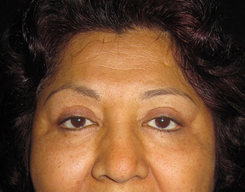 Eyelid Surgery Before & After Gallery - Patient 122908965 - Image 2