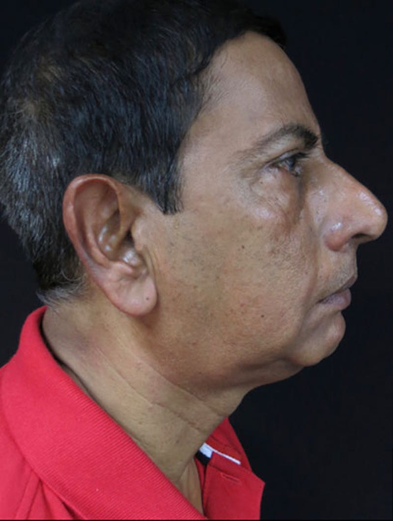 Face & Neck Lift Before & After Gallery - Patient 122908969 - Image 5