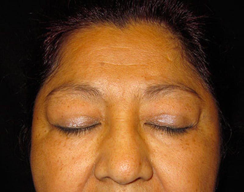 Eyelid Surgery Before & After Gallery - Patient 122908965 - Image 3