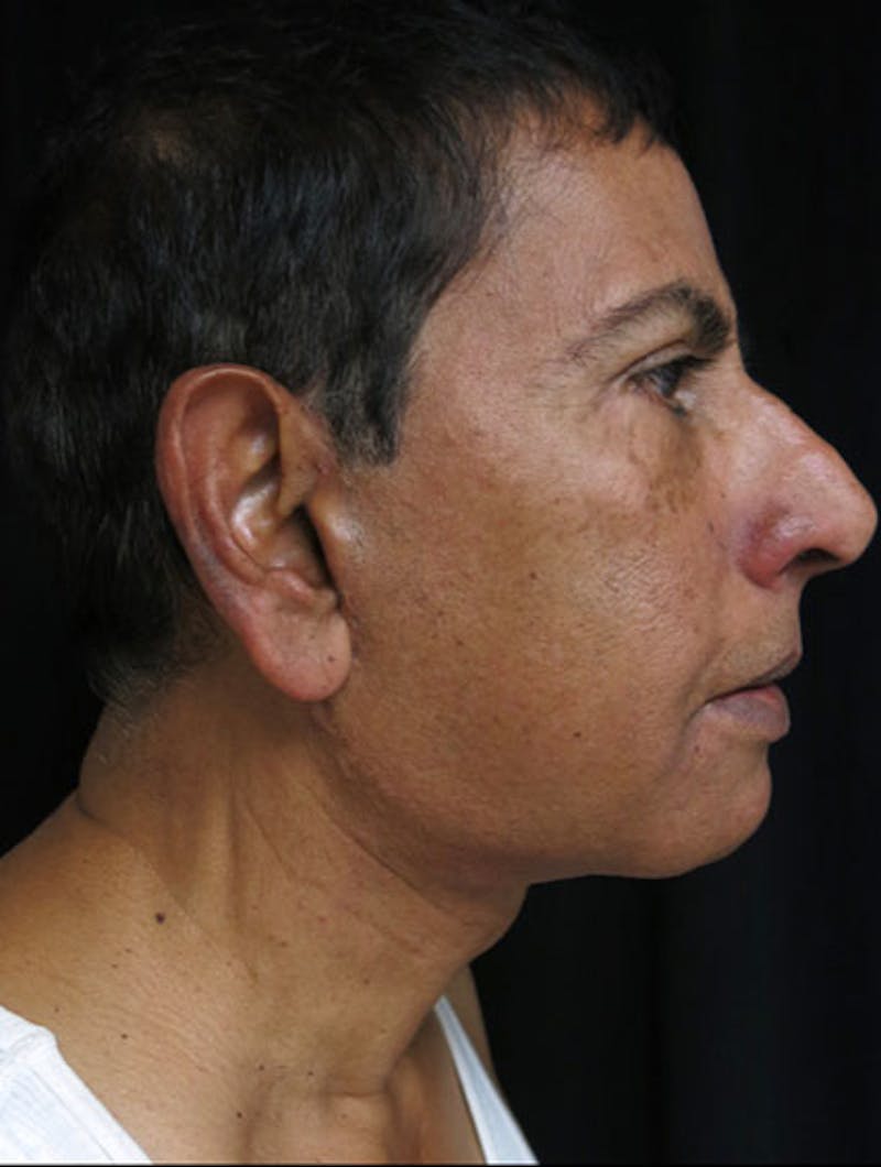 Face & Neck Lift Before & After Gallery - Patient 122908969 - Image 6