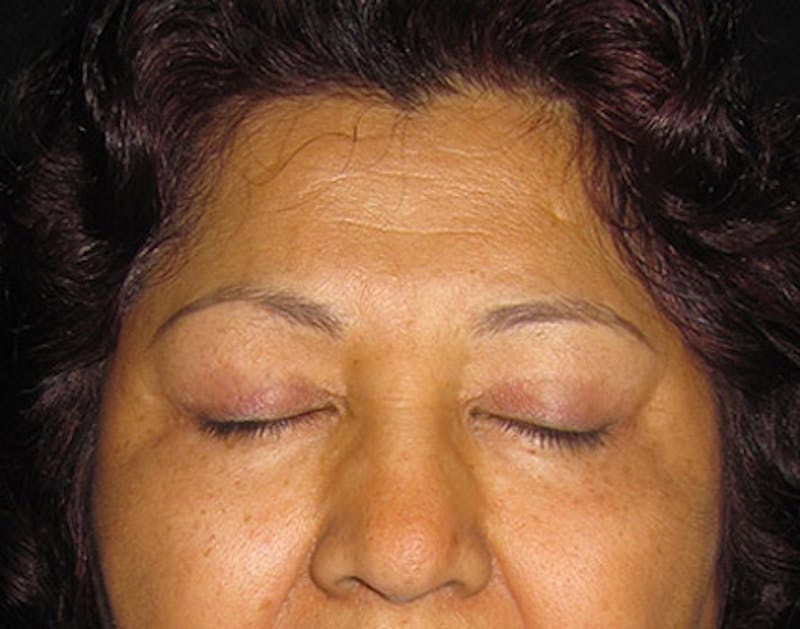 Eyelid Surgery Before & After Gallery - Patient 122908965 - Image 4
