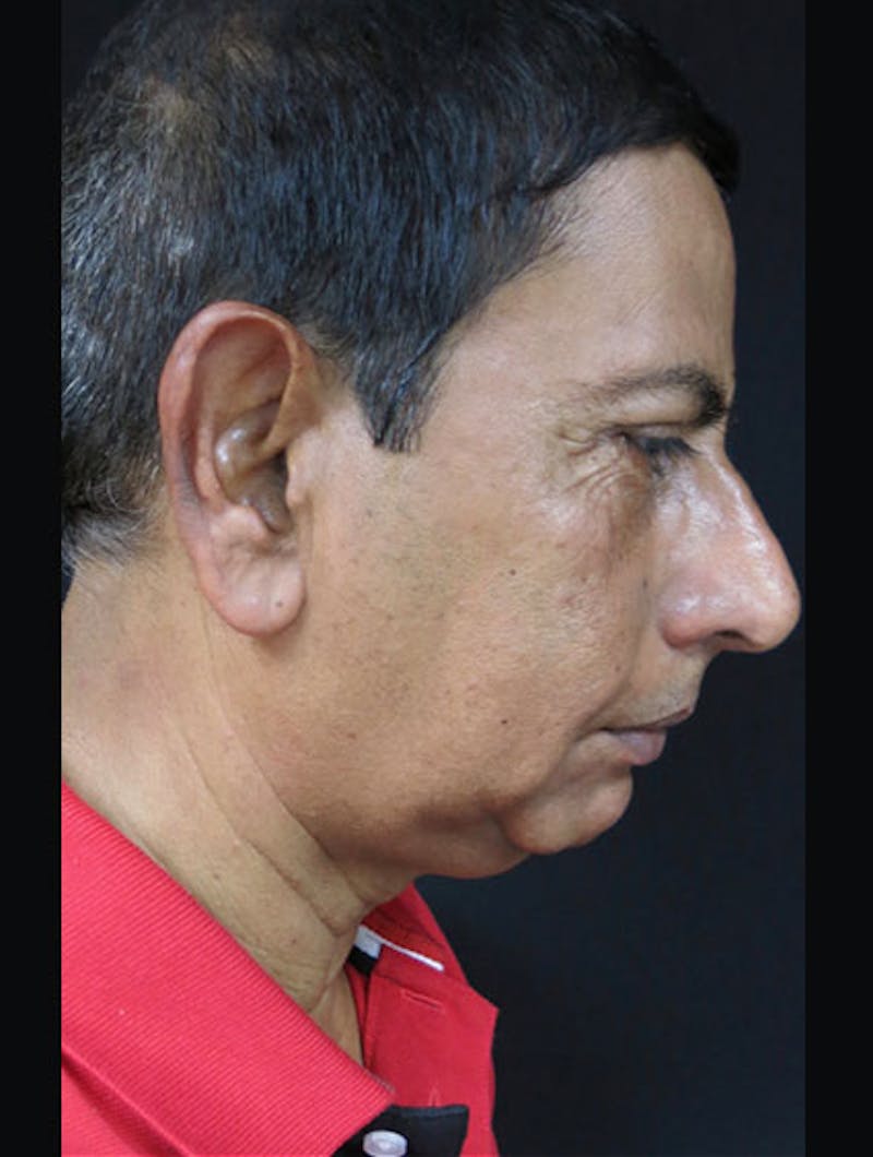 Face & Neck Lift Before & After Gallery - Patient 122908969 - Image 7