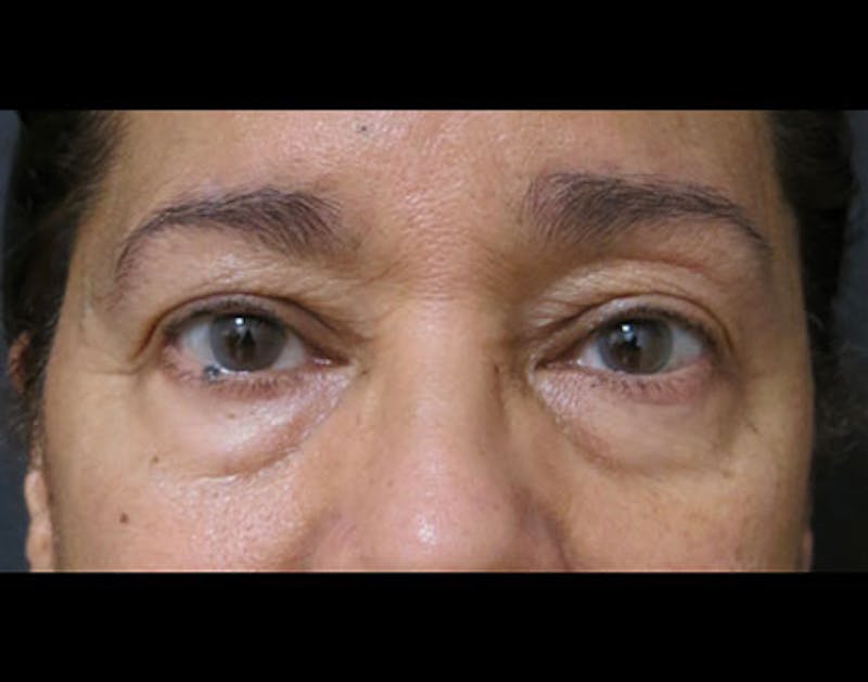 Eyelid Surgery Before & After Gallery - Patient 122908967 - Image 1