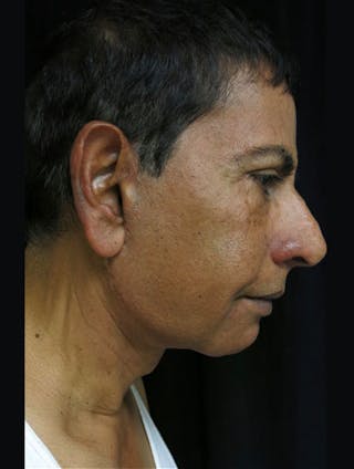 Face & Neck Lift Before & After Gallery - Patient 122908969 - Image 8