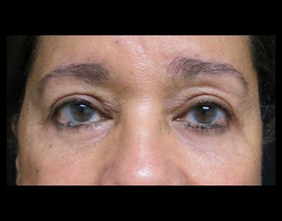 Eyelid Surgery Before & After Gallery - Patient 122908967 - Image 2