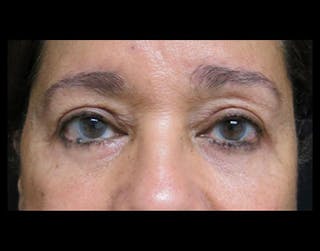 Eyelid Surgery Before & After Gallery - Patient 122908967 - Image 2