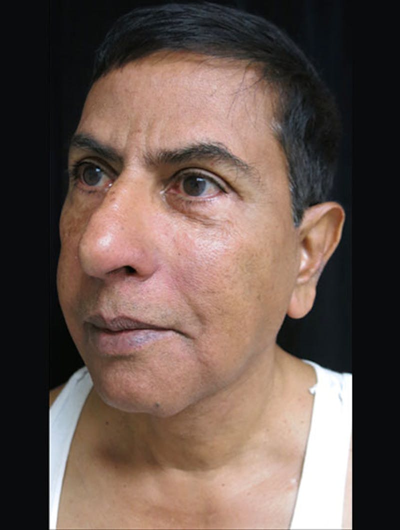Face & Neck Lift Before & After Gallery - Patient 122908969 - Image 10
