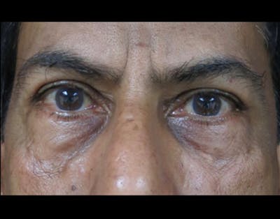 Eyelid Surgery Before & After Gallery - Patient 122908968 - Image 1