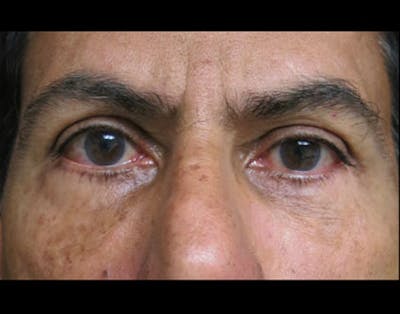 Eyelid Surgery Before & After Gallery - Patient 122908968 - Image 2