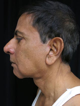 Face & Neck Lift Before & After Gallery - Patient 122908969 - Image 12