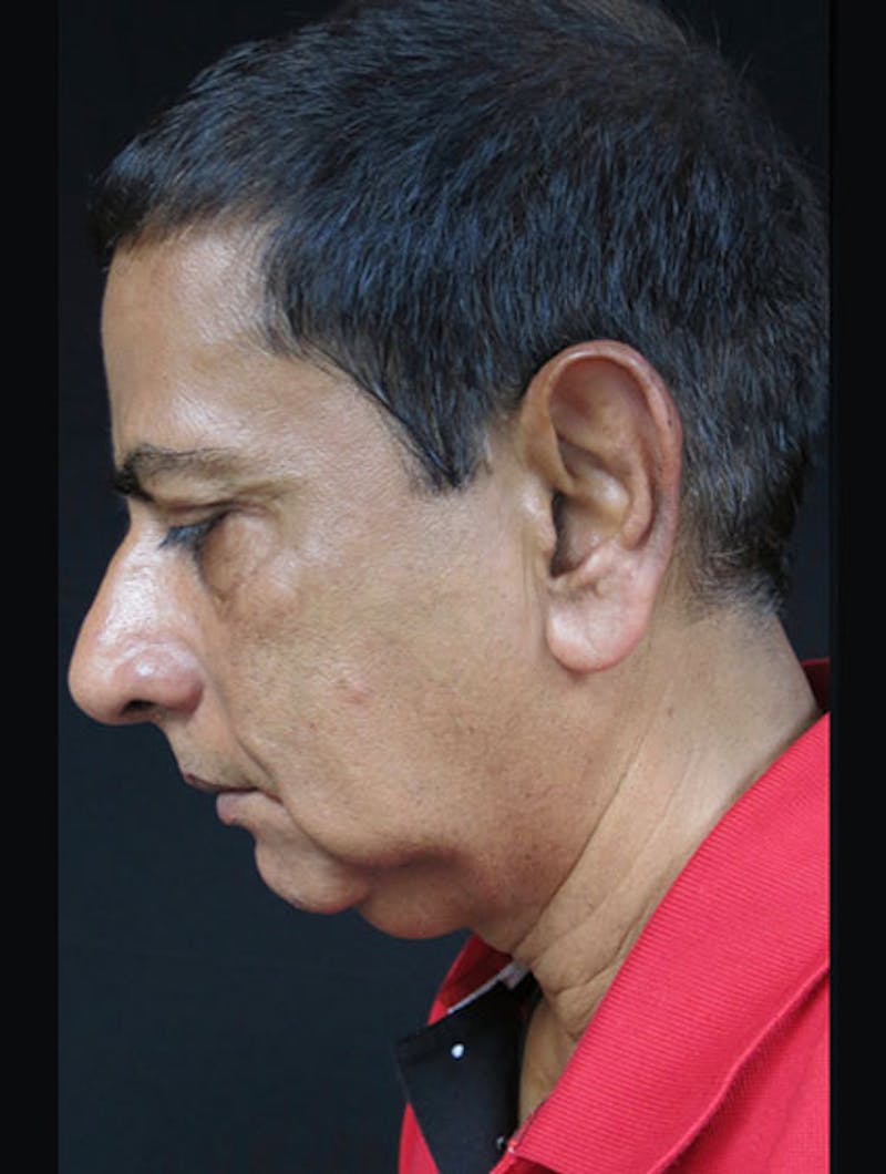 Face & Neck Lift Before & After Gallery - Patient 122908969 - Image 13