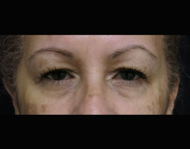 Eyelid Surgery Before & After Gallery - Patient 122908970 - Image 1
