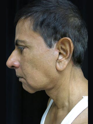 Face & Neck Lift Before & After Gallery - Patient 122908969 - Image 14