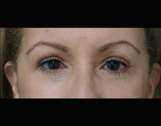 Eyelid Surgery Before & After Gallery - Patient 122908970 - Image 2