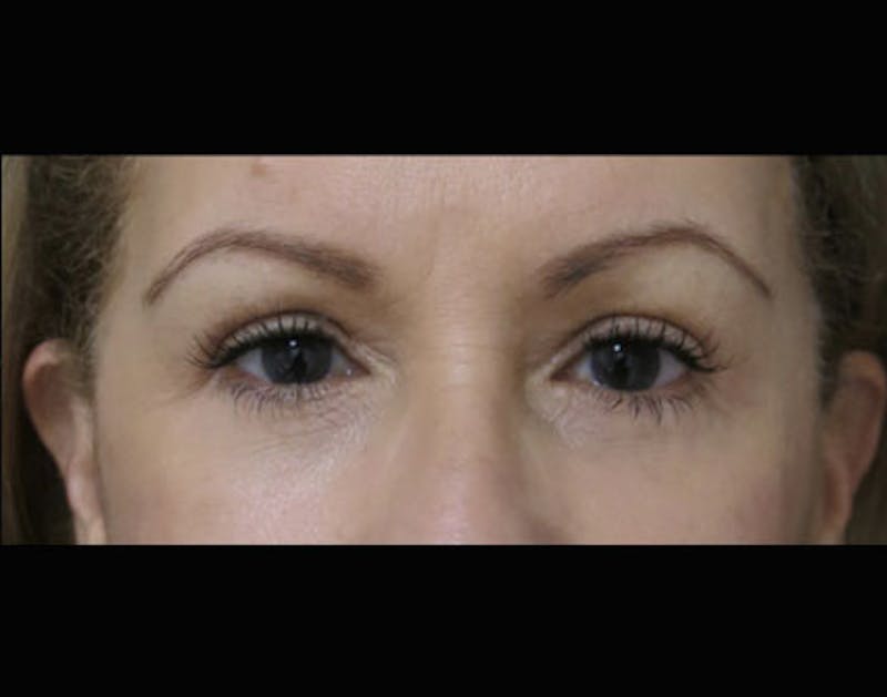 Eyelid Surgery Before & After Gallery - Patient 122908970 - Image 2