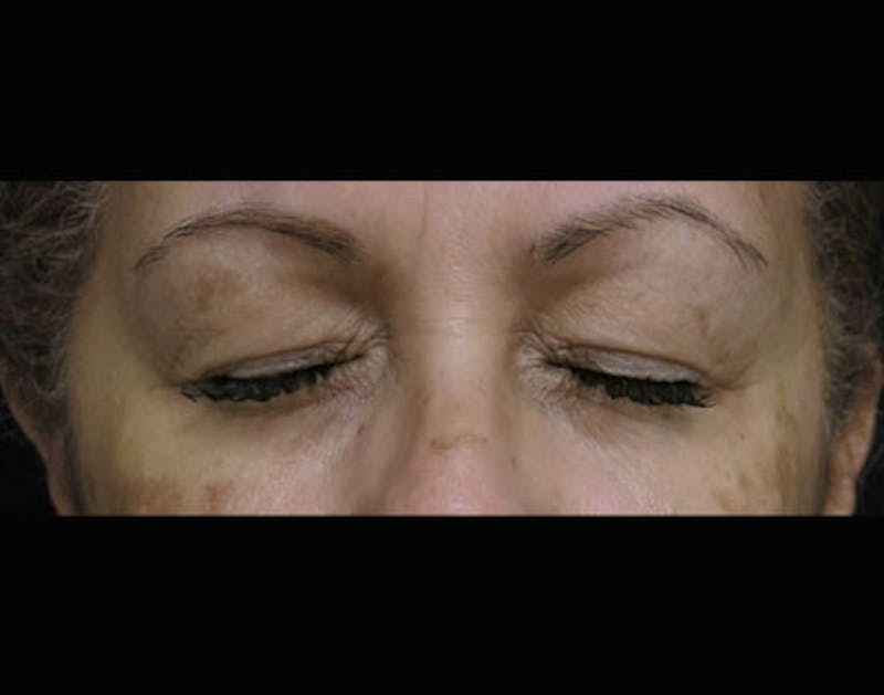 Eyelid Surgery Before & After Gallery - Patient 122908970 - Image 3