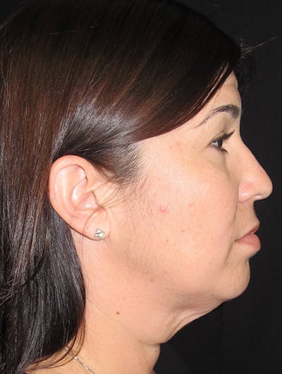 Face & Neck Lift Before & After Gallery - Patient 122908975 - Image 1