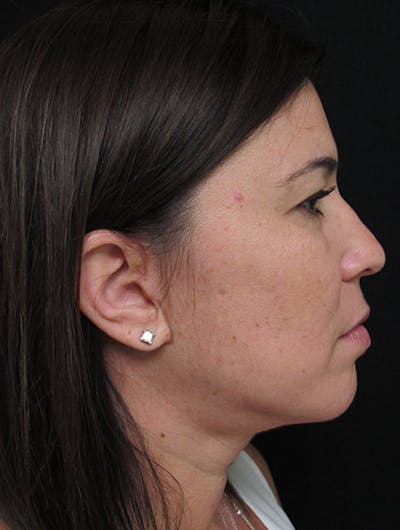 Face & Neck Lift Before & After Gallery - Patient 122908975 - Image 2