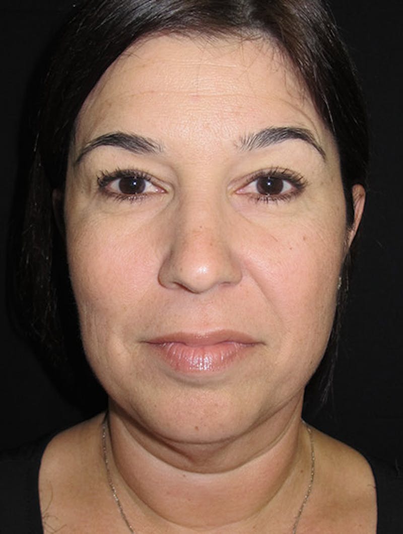 Face & Neck Lift Before & After Gallery - Patient 122908975 - Image 3
