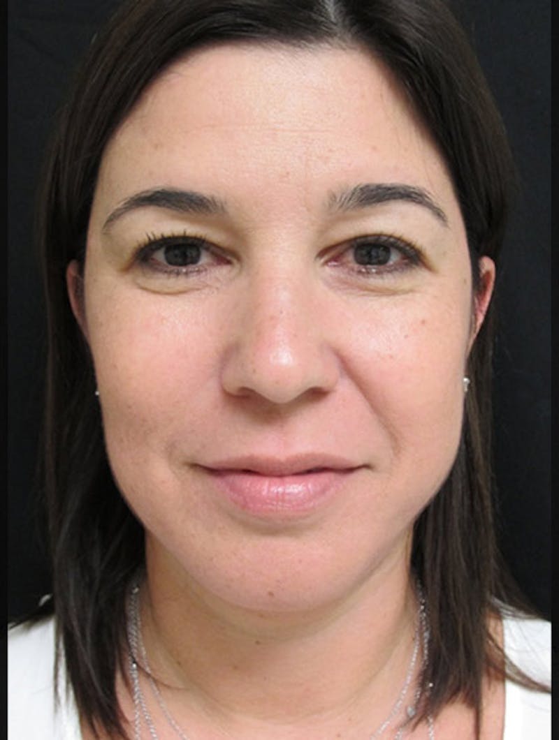 Face & Neck Lift Before & After Gallery - Patient 122908975 - Image 4