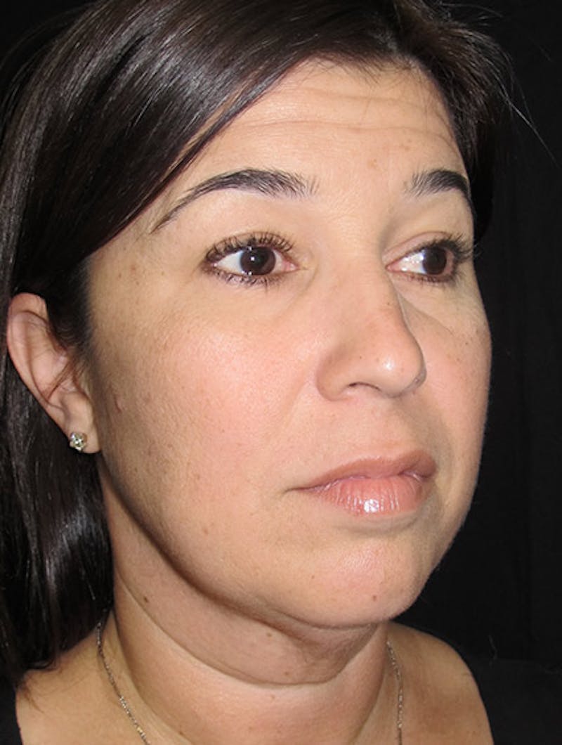 Face & Neck Lift Before & After Gallery - Patient 122908975 - Image 5