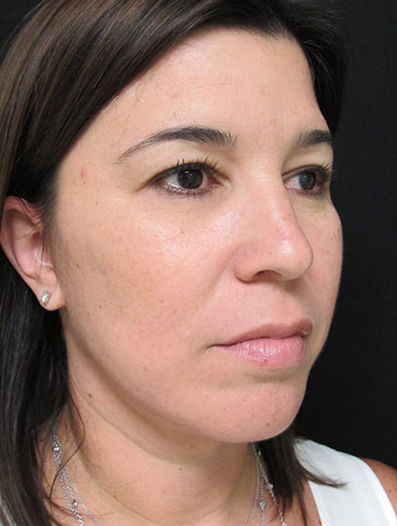 Face & Neck Lift Before & After Gallery - Patient 122908975 - Image 6