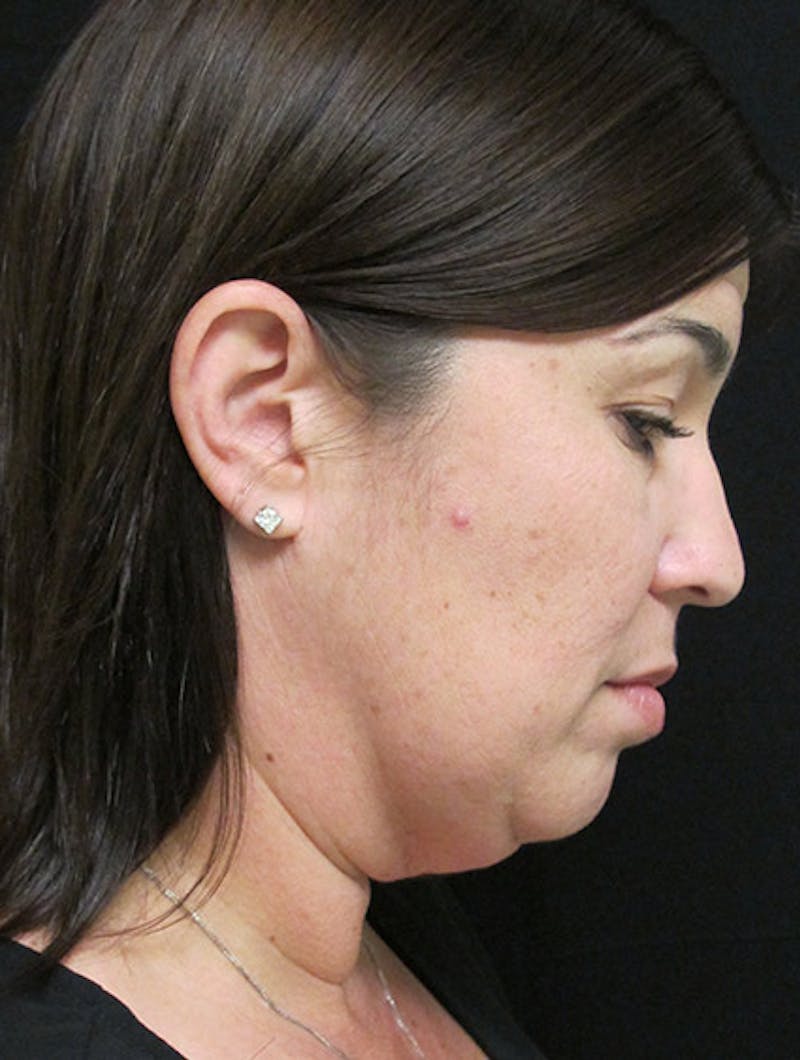Face & Neck Lift Before & After Gallery - Patient 122908975 - Image 7