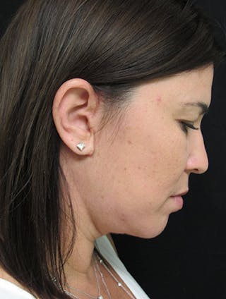 Face & Neck Lift Before & After Gallery - Patient 122908975 - Image 8