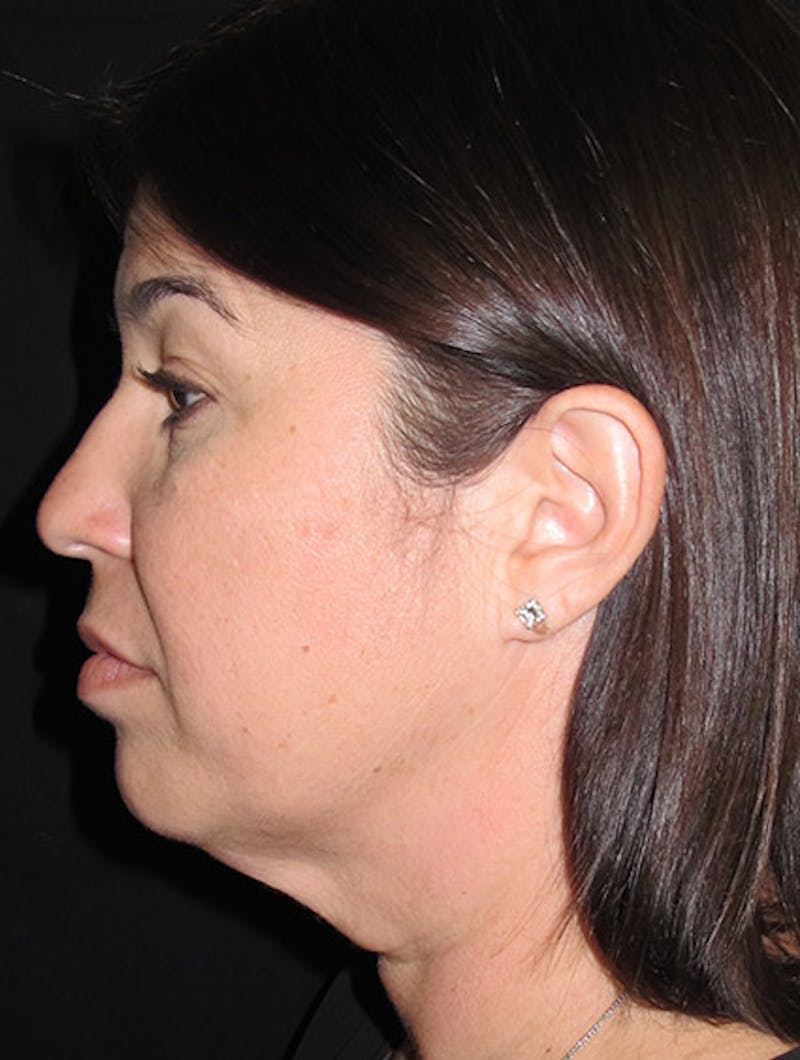 Face & Neck Lift Before & After Gallery - Patient 122908975 - Image 9
