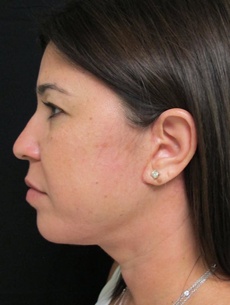 Face & Neck Lift Before & After Gallery - Patient 122908975 - Image 10