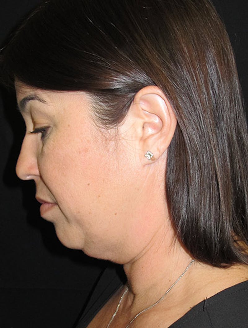 Face & Neck Lift Before & After Gallery - Patient 122908975 - Image 11