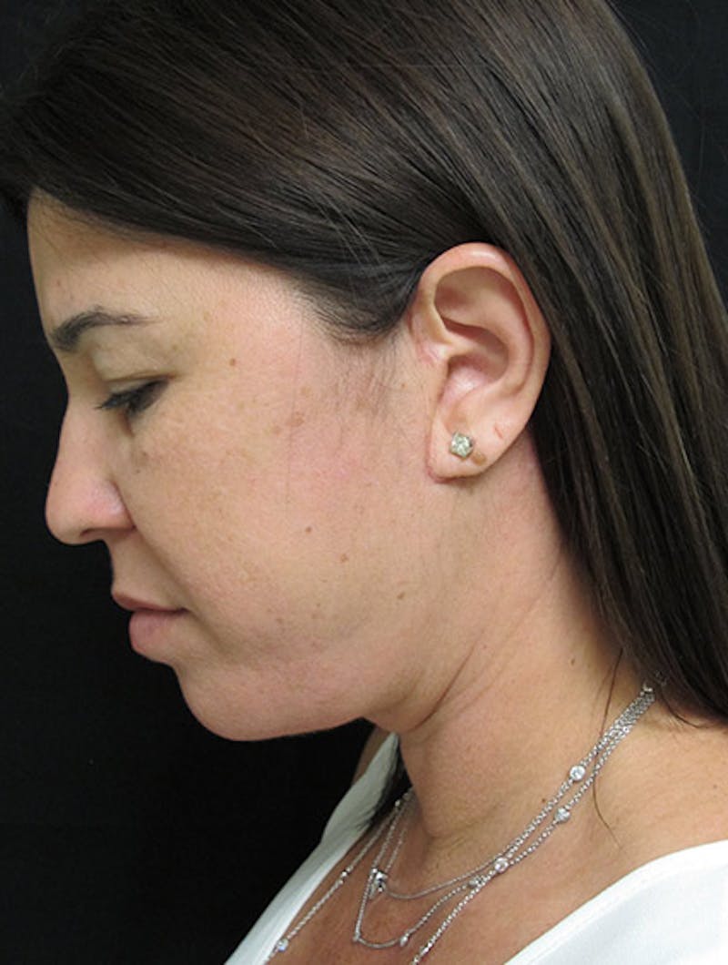 Face & Neck Lift Before & After Gallery - Patient 122908975 - Image 12