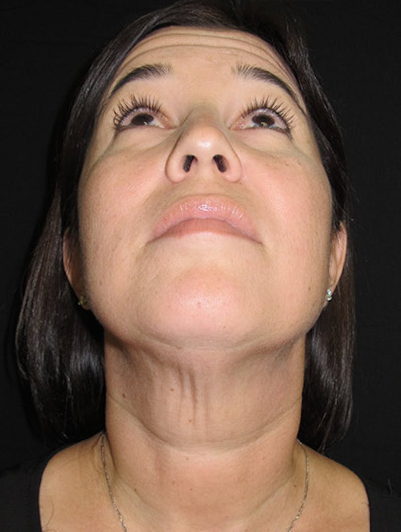 Face & Neck Lift Before & After Gallery - Patient 122908975 - Image 13