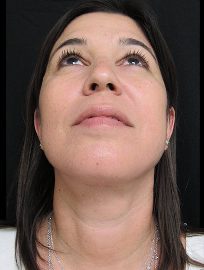 Face & Neck Lift Before & After Gallery - Patient 122908975 - Image 14