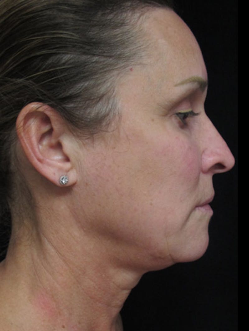 Before and after Facelift surgery in Miami with Dr. Lampert