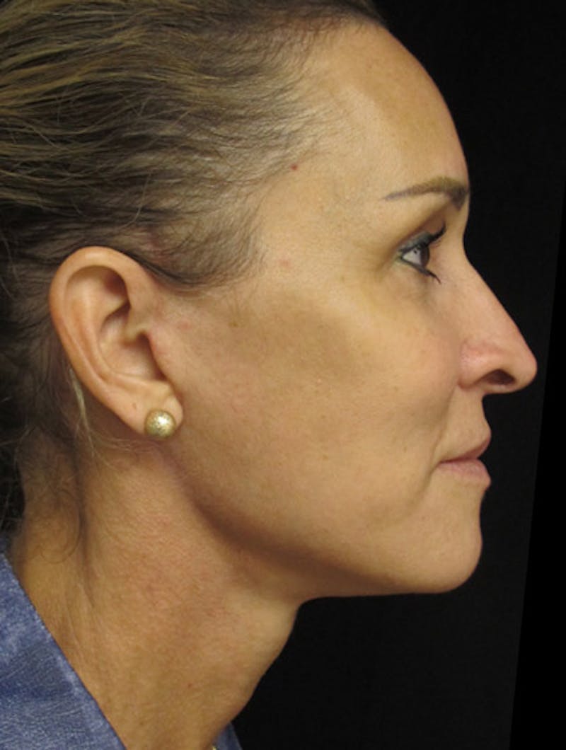 Before and after Facelift surgery in Miami with Dr. Lampert