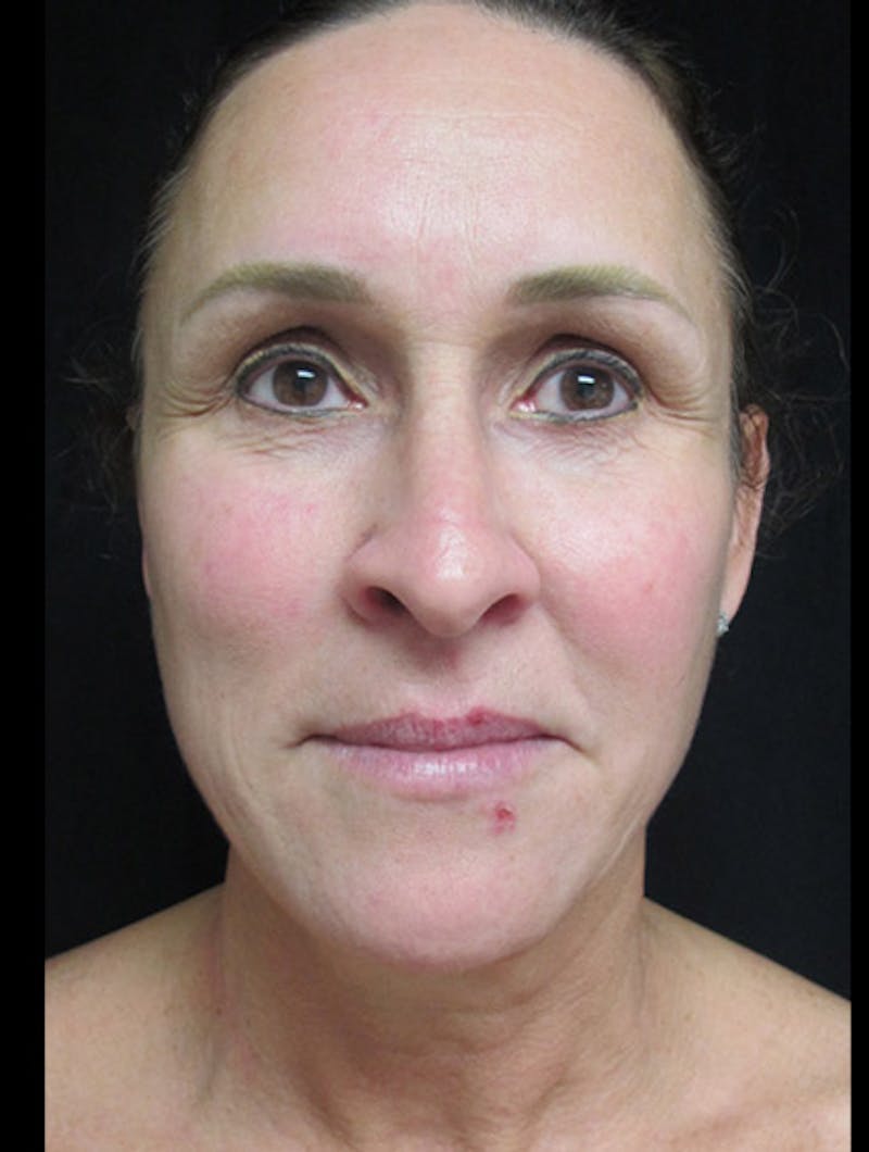 Face & Neck Lift Before & After Gallery - Patient 122908982 - Image 3