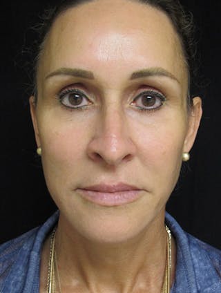 Face & Neck Lift Before & After Gallery - Patient 122908982 - Image 4