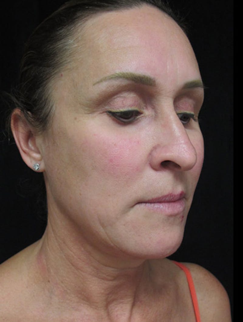 Face & Neck Lift Before & After Gallery - Patient 122908982 - Image 5