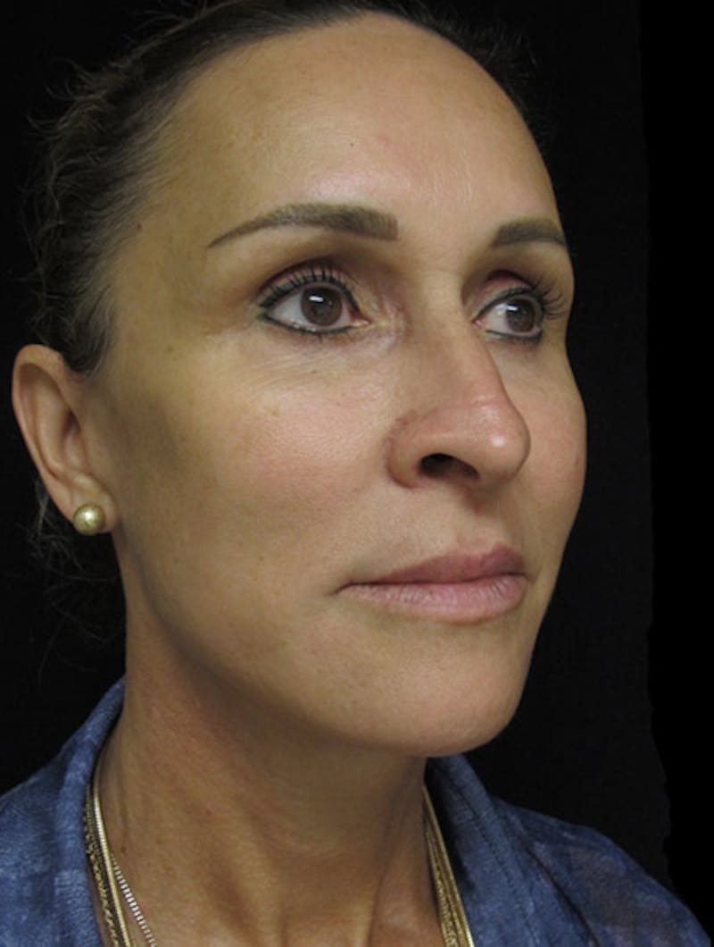 Face & Neck Lift Before & After Gallery - Patient 122908982 - Image 6