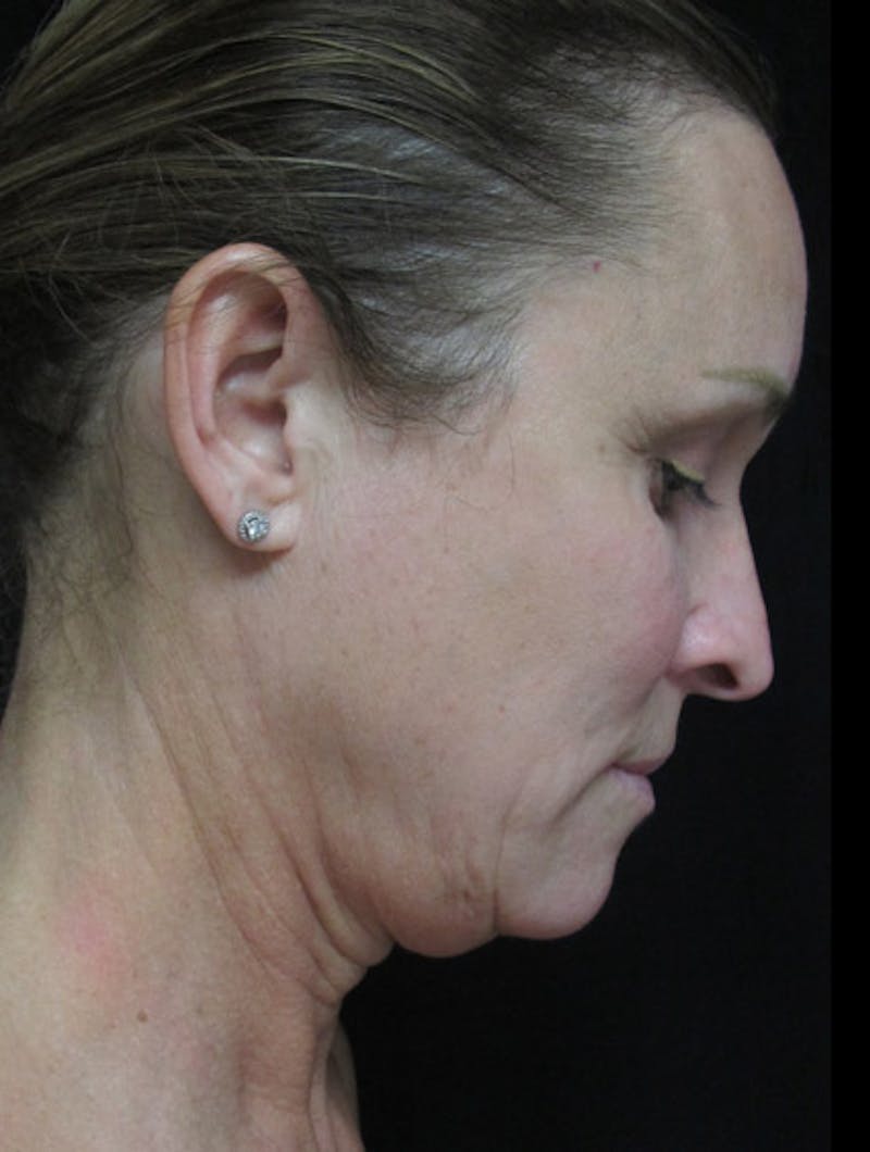 Face & Neck Lift Before & After Gallery - Patient 122908982 - Image 7