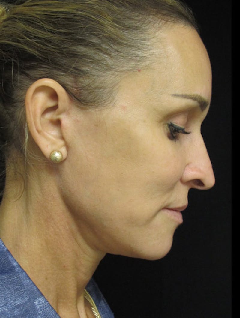 Face & Neck Lift Before & After Gallery - Patient 122908982 - Image 8