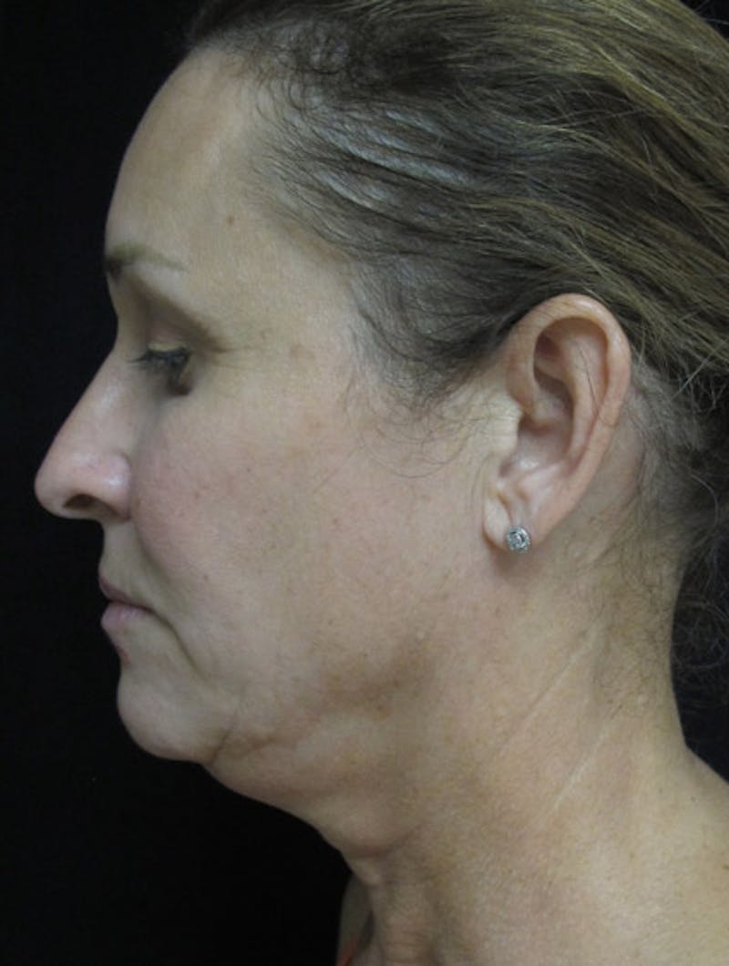 Face & Neck Lift Before & After Gallery - Patient 122908982 - Image 9