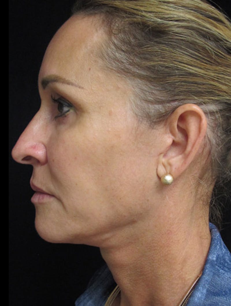 Face & Neck Lift Before & After Gallery - Patient 122908982 - Image 10