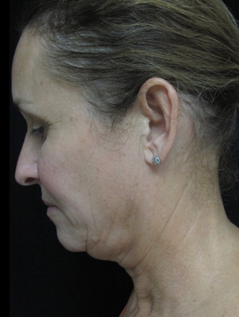 Face & Neck Lift Before & After Gallery - Patient 122908982 - Image 11