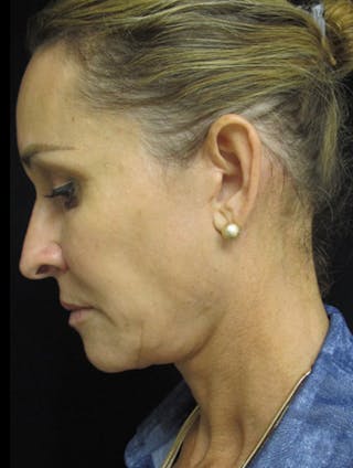 Face & Neck Lift Before & After Gallery - Patient 122908982 - Image 12